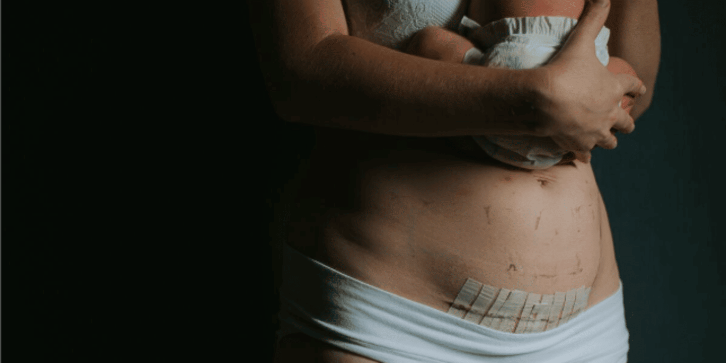 mom showing c-section or belly birth scar