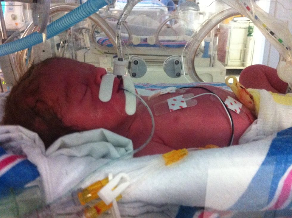 baby in NICU