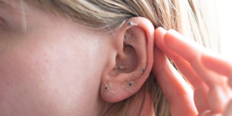 woman shows acupuncture on the ear - ear seeds for morning sickness